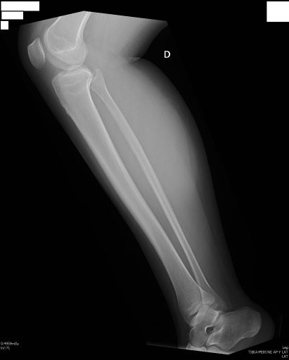 Posicionamiento Lateral de Pierna